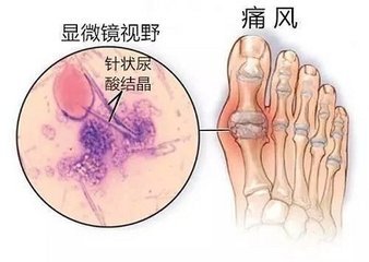 痛风一个月发作一次